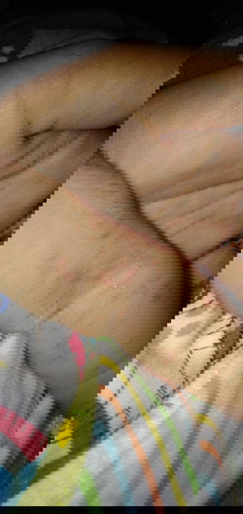 Bintik² merah dan seperti bisul