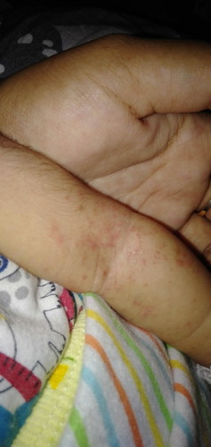 Bintik² merah dan seperti bisul