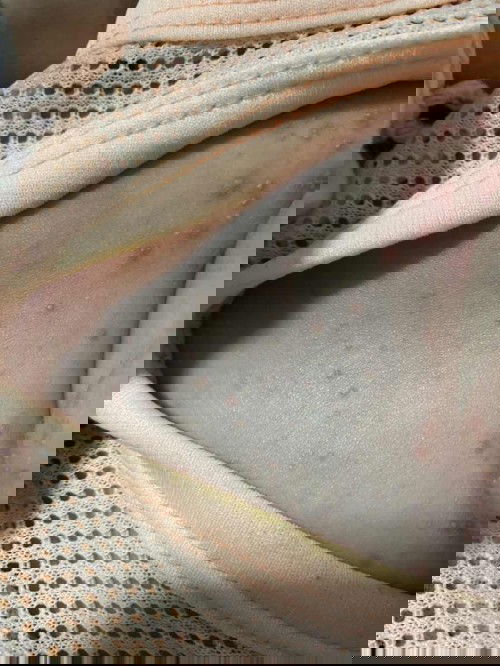 ตุ่มขึ้นแบบนี้คืออะไรคะแม่ๆน้องแม่ๆมีใครเคยเป็นมั้ยคะ