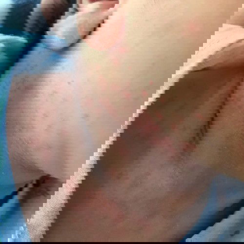 ผื่นแบบนี้เกิดจากอะไรคะ