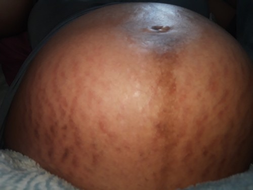 Stretch marks During pregnancy