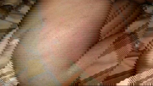 Merah pada kulit bayi