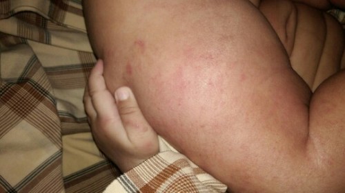 Merah pada kulit bayi