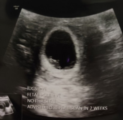 early pregnancy