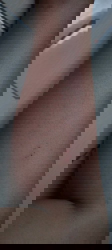 Saya hamil 15weeks, di kaki muncul bintik2 merah dan persendian kaku. Apakah ada yg pernah mengalami