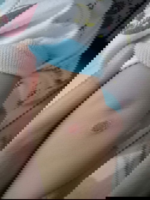 Luka bundar pada kulit bayi