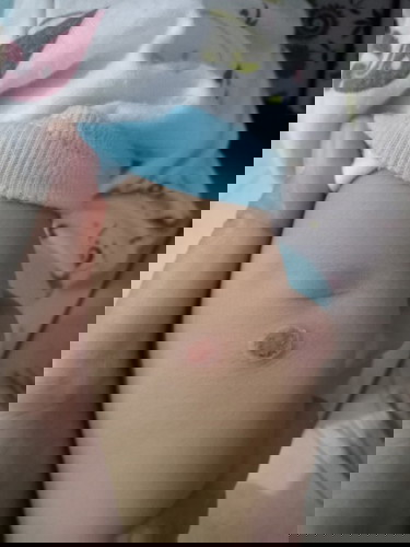 Luka bundar pada kulit bayi