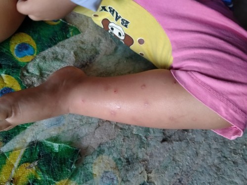 ขาเป็นตุ่ม