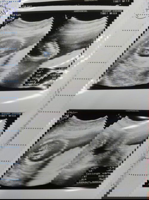 พบถุงน้ำในหัวทารก