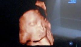 แม่ท้องตรวจช่องคลอดเจอเชื้อGBS