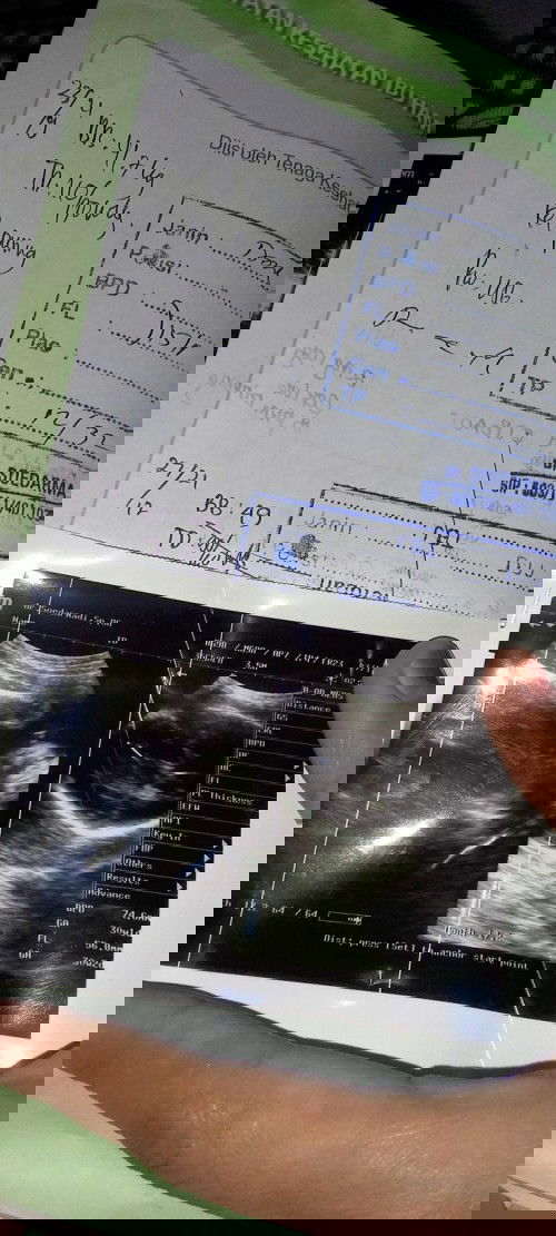 Pergerakan janin lambat kurang oksigen dan posisi sungsang