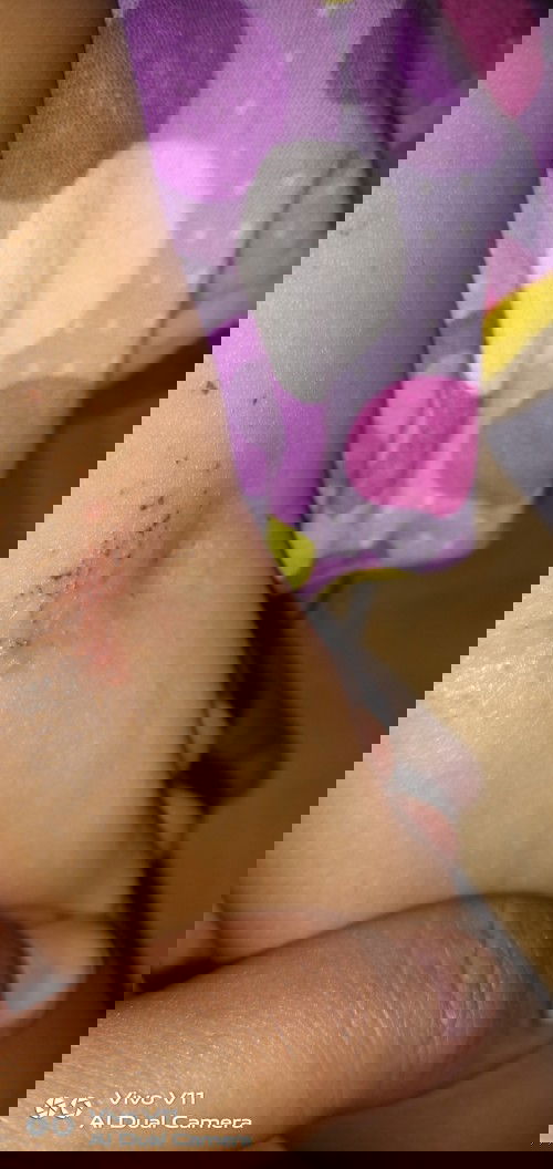 Gatal pada tangan anak