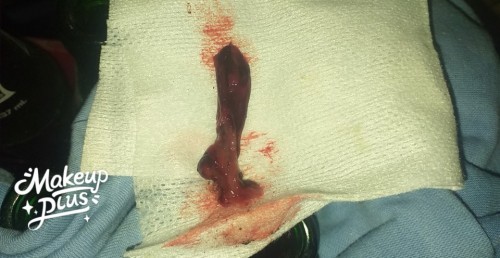 Bleeding, Headache, Upper left side abdominal cramps