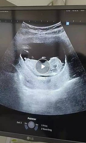 คุณแม่เคยมีประวัติเป็น PCOS