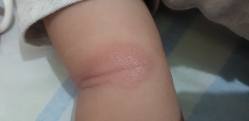 Rashes o buni?