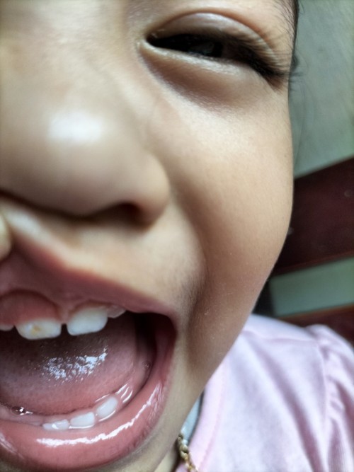 Gigi bayi karies plak