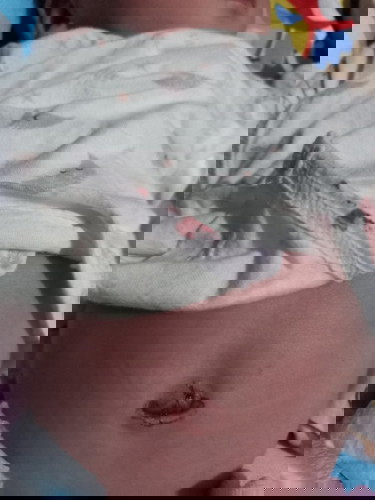 สะดือน้องเลือดออก