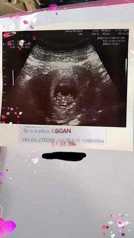 อยากทราบที่เห็นเป๋นก้อนๆๆนี้คือตัวเด็กหรือป่าวคะ ท้องแรกดูไม่เป็นค่ะ