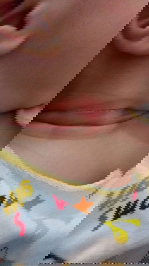 Lecet di leher bayi 2 bulan