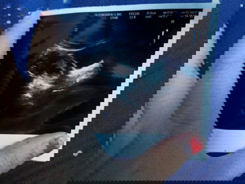 7w2d ไม่พบลูก ไม่มีเสียงหัวใจ