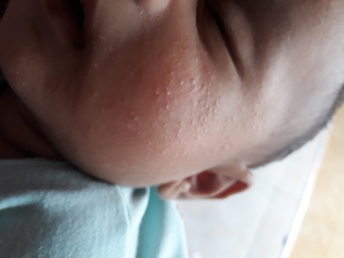 Bintik2 di kulit baby