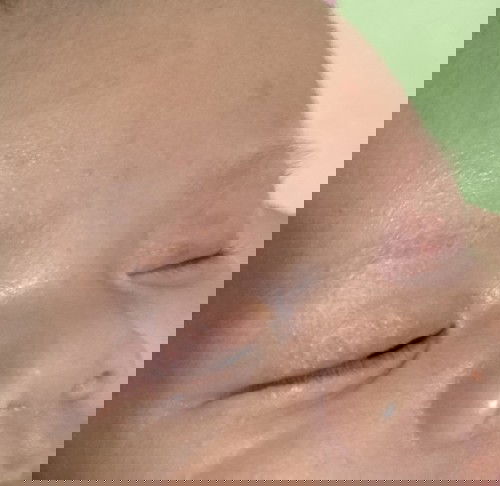 Butlig sa talukap ng mata ni baby