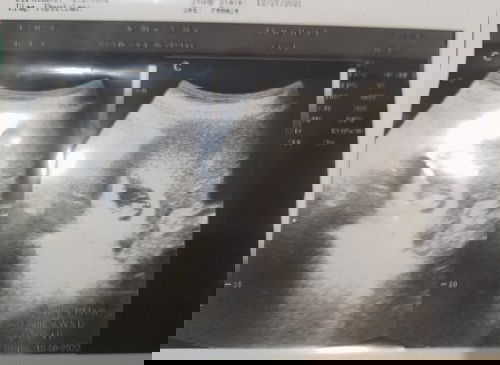 Hasil usg 7weeks kantung janin tidak bulat dan ada sudutnya