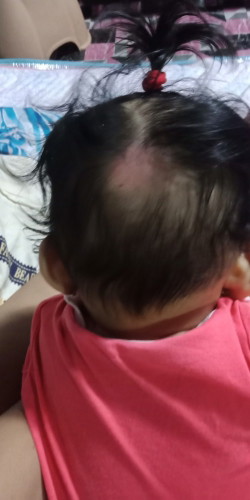 Helo Mga momshie anu poh kaya gamot Sa ulo ni baby namumula poh siya...