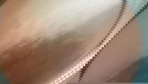 Pangangati ng areola habang buntis