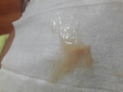 mucus plug