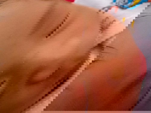 Bé được 17d rồi ạ từ lúc mới sinh bé đã bị nổi mụn đầu trắng li ti khắp mặt rồi đỏ lên