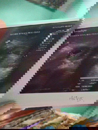 Hasil usg dan usia kehamilan berbeda