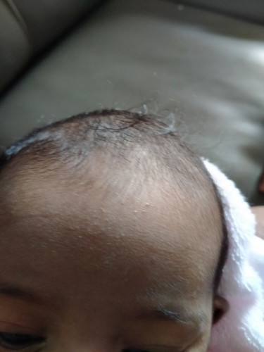 Hi baby sy 1 bln 15 ,Sy bg susu formula dupro, tapi kulit baby sy ada mcm nie, kena tukar susu ke?