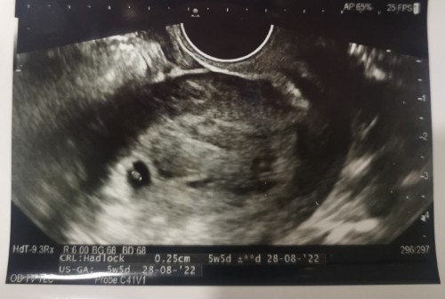 Larger yolk sac at 5 week 5 day