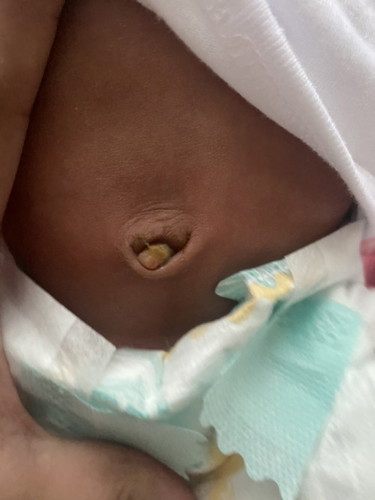 mga mamsh pa help po nalaglag n ung pusod ng baby ko pero may ganto po sa pusod nya ano po ito at anong dapat gawin?