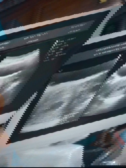 Perdarahan hamil 7 minggu