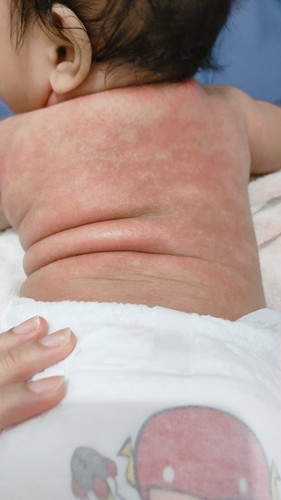 Kulit bayi merah2
