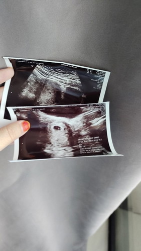 Treatened Miscarriage