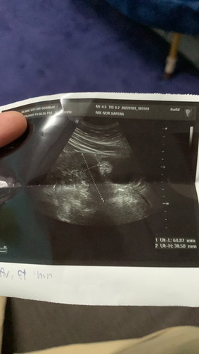 Ada siptom hamil tapi scan takde kantung