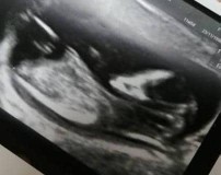 Gambar Scan 11w 5d