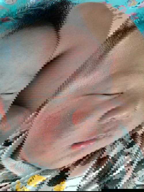 ผื่นขึ้นที่หน้า