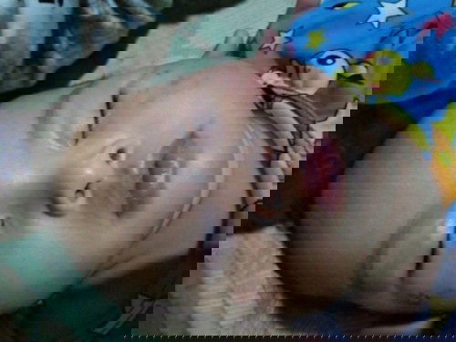 RASHES NUNG UMPISA NGAYON LUMALALA