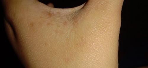 Gatal pada saat hamil apakah normal???