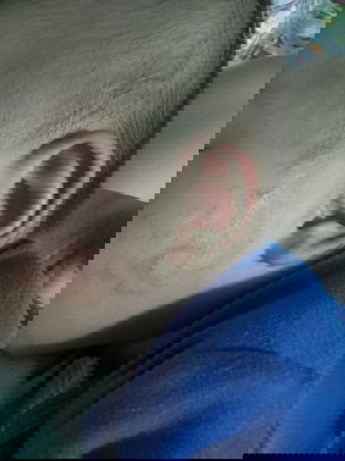 Is this heat rashes?