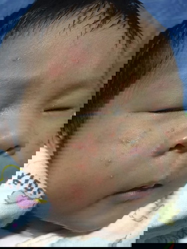 แบบนี้ผื่นหรือสิวทารกคะ รักษายังไงดี ต้องหาหมอไหมคะ