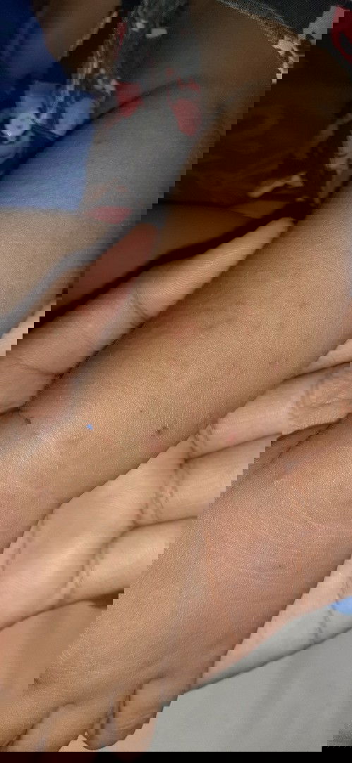 Ini bintik alergi atau cacar?