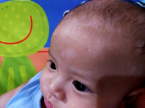 Anu po magandang gamot parang mapa ang muka ng anak ko dahil sa puti puti nagkalat .. i think makati