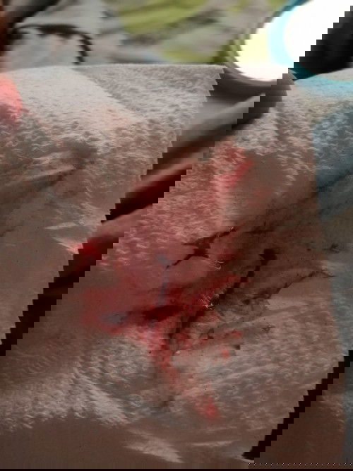 Nose bleed during pregnancy