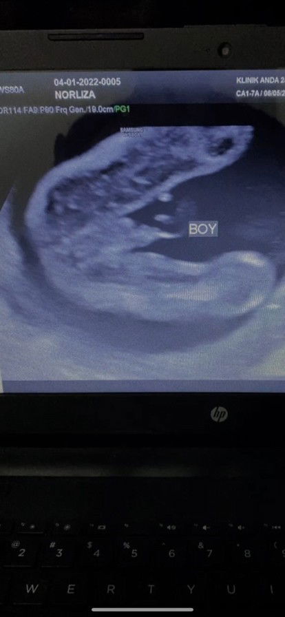 Buat Details scan week 22 . Ingatkan gegirl rupanya boboy 😆