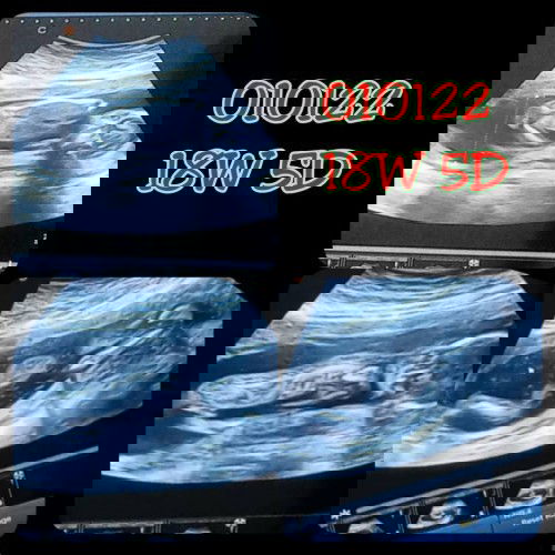 Peneman semasa bersalin